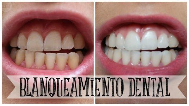 Precio de blanqueo dental