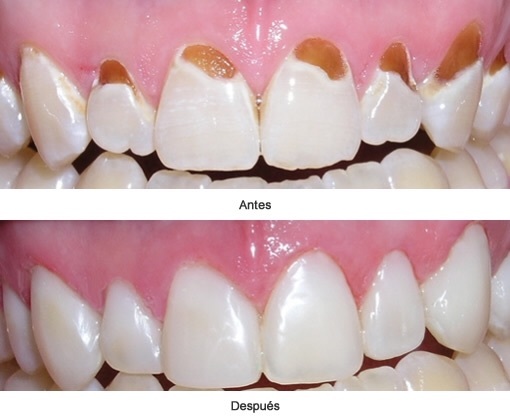 Mil Anuncios Com Empaste Dental Segunda Mano Y Anuncios Clasificados