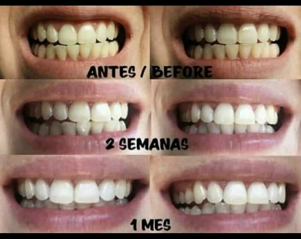 Mil Anuncios Com Blanqueador Dental Segunda Mano Y Anuncios Clasificados